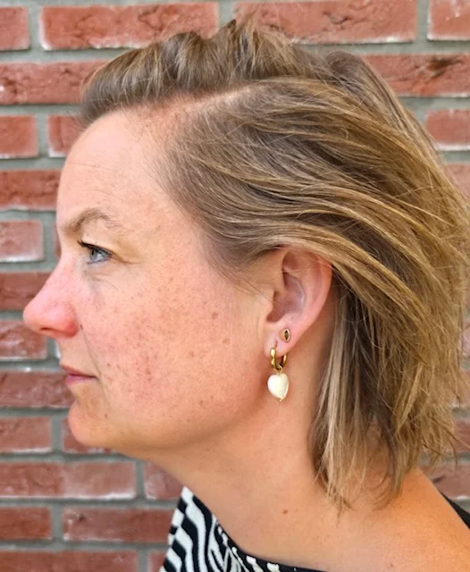 vrouw met pigmentvlekken