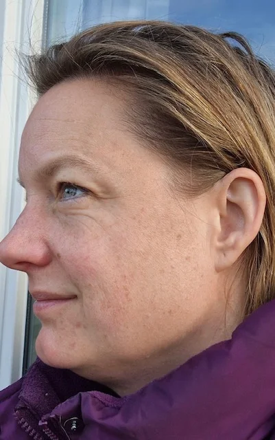 vrouw met pigmentvlekken